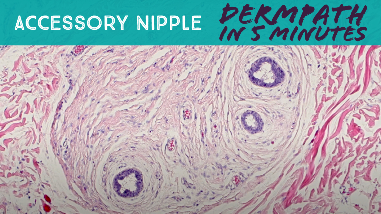 Accessory Nipple Dermpath in 5 Minutes (video) KiKo XP